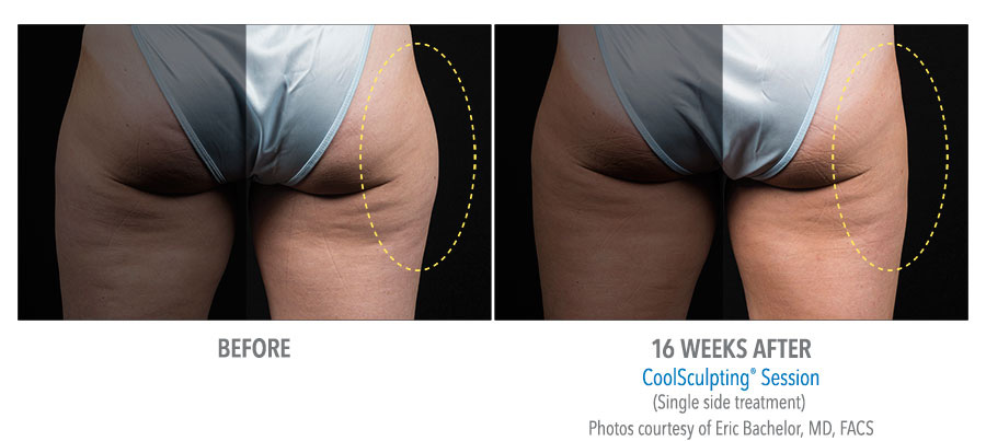 What Is Coolsculpting