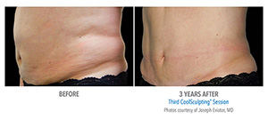 CoolSculpting Miami, FL