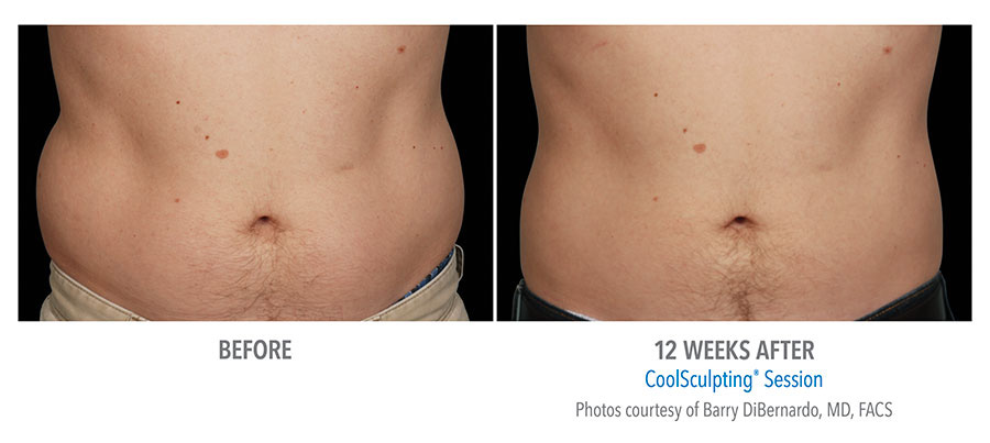 How It Works Coolsculpting