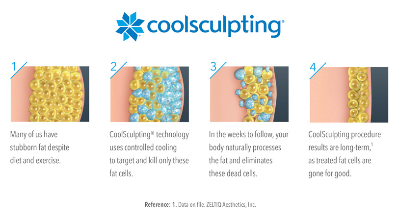 CoolSculpting Miami, FL