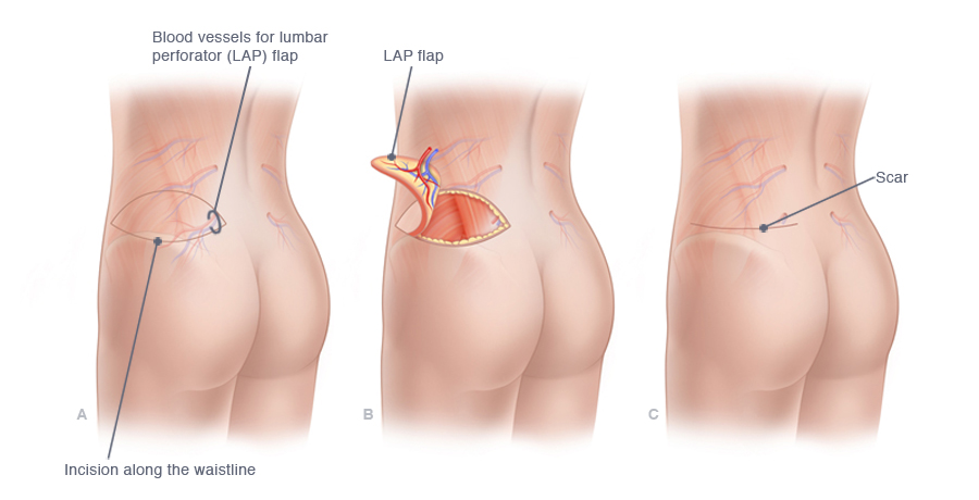 popup-LAP_Flap_lg