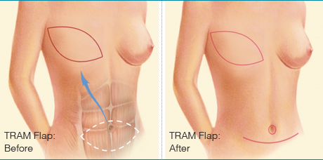 breast reconstruction tran flap Naked kerry katona