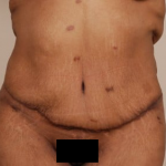 Tummy Tuck Before & After Patient #494