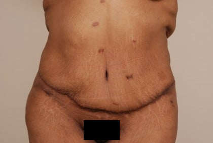 Tummy Tuck Before & After Patient #494