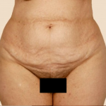 Tummy Tuck Before & After Patient #471