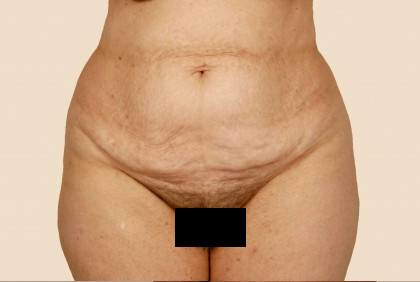 Tummy Tuck Before & After Patient #471