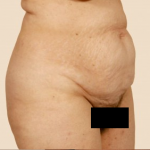 Tummy Tuck Before & After Patient #471