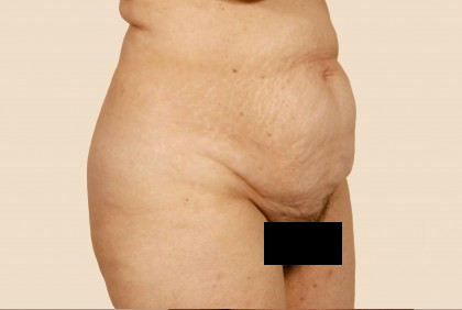 Tummy Tuck Before & After Patient #471