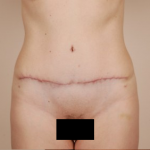 Tummy Tuck Before & After Patient #434