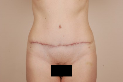 Tummy Tuck Before & After Patient #434