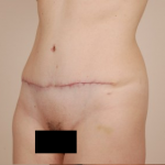 Tummy Tuck Before & After Patient #434