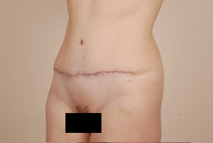 Tummy Tuck Before & After Patient #434