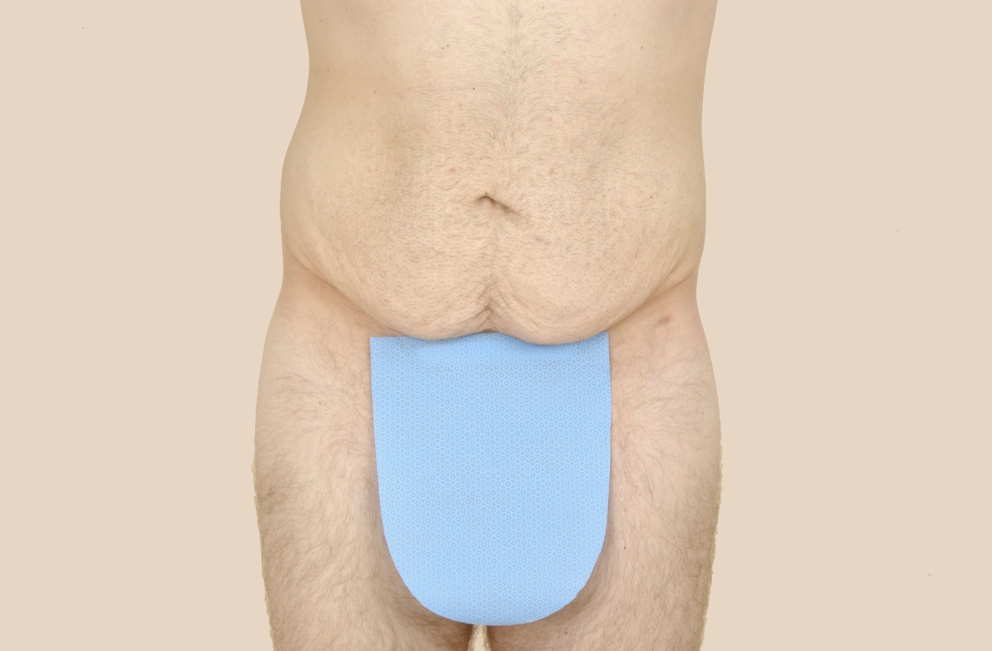 Tummy Tuck Before & After Patient #451