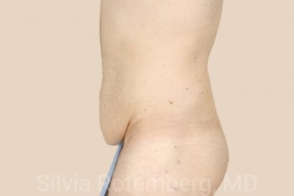 Tummy Tuck Before & After Patient #451