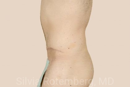 Tummy Tuck Before & After Patient #451