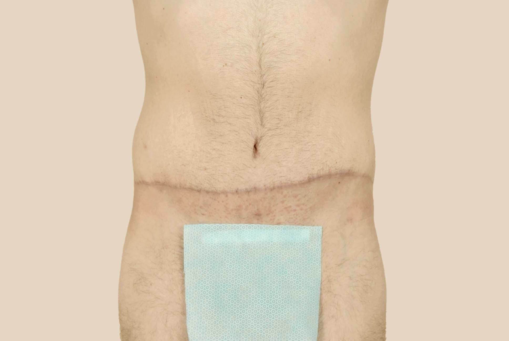 Tummy Tuck Before & After Patient #451