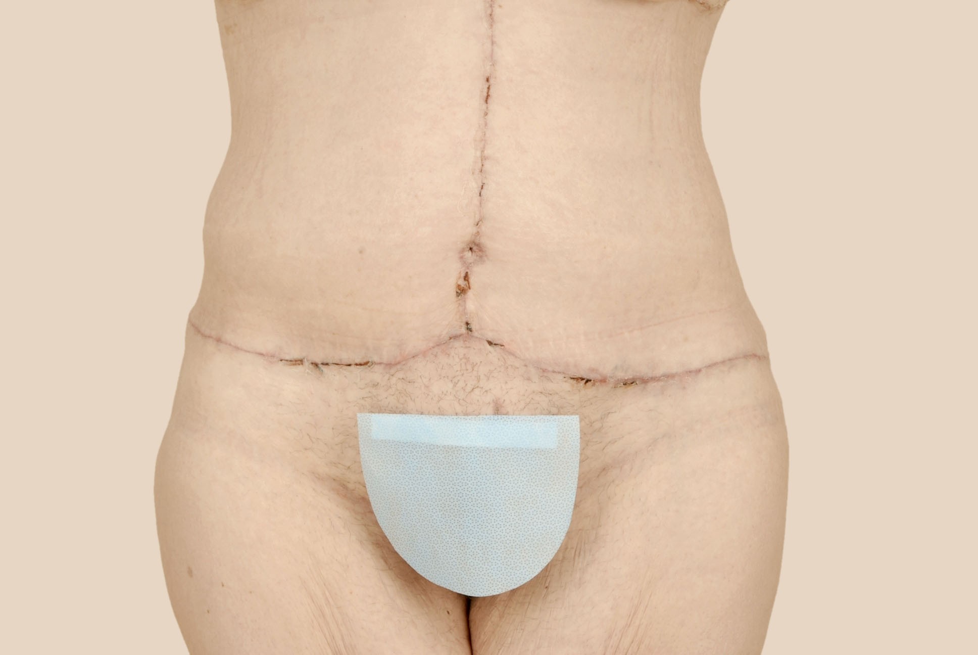 Tummy Tuck Before & After Patient #476