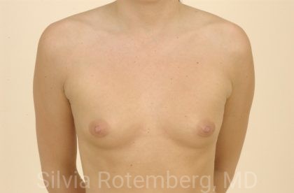 Breast Augmentation Before & After Patient #373