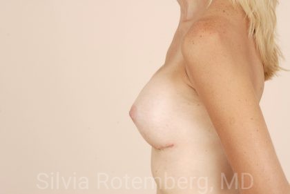 Breast Augmentation Before & After Patient #379