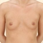 Breast Augmentation Before & After Patient #386