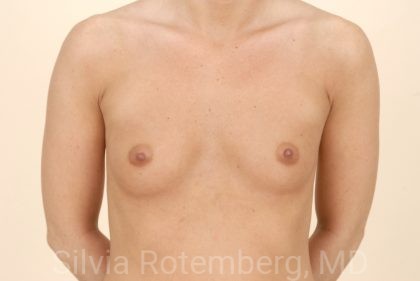Breast Augmentation Before & After Patient #386