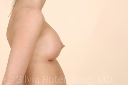 Breast Augmentation Before & After Patient #386