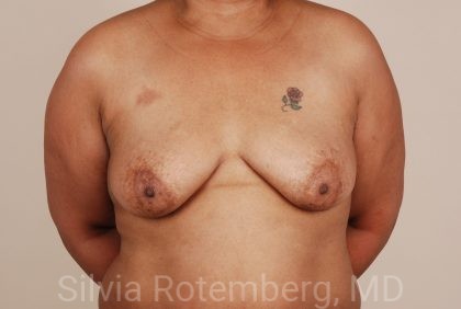 Breast Augmentation Before & After Patient #396