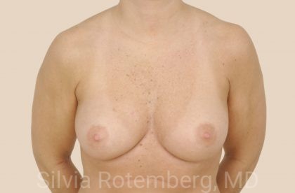 Breast Reconstruction Before & After Patient #402