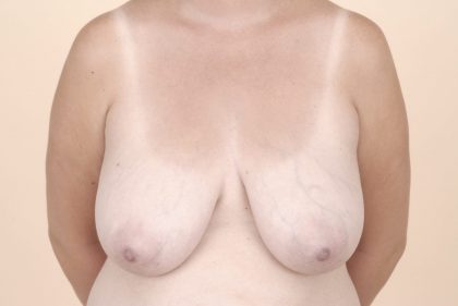 Breast Reduction Before & After Patient #601
