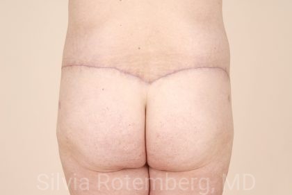 Body Lift Before & After Patient #499