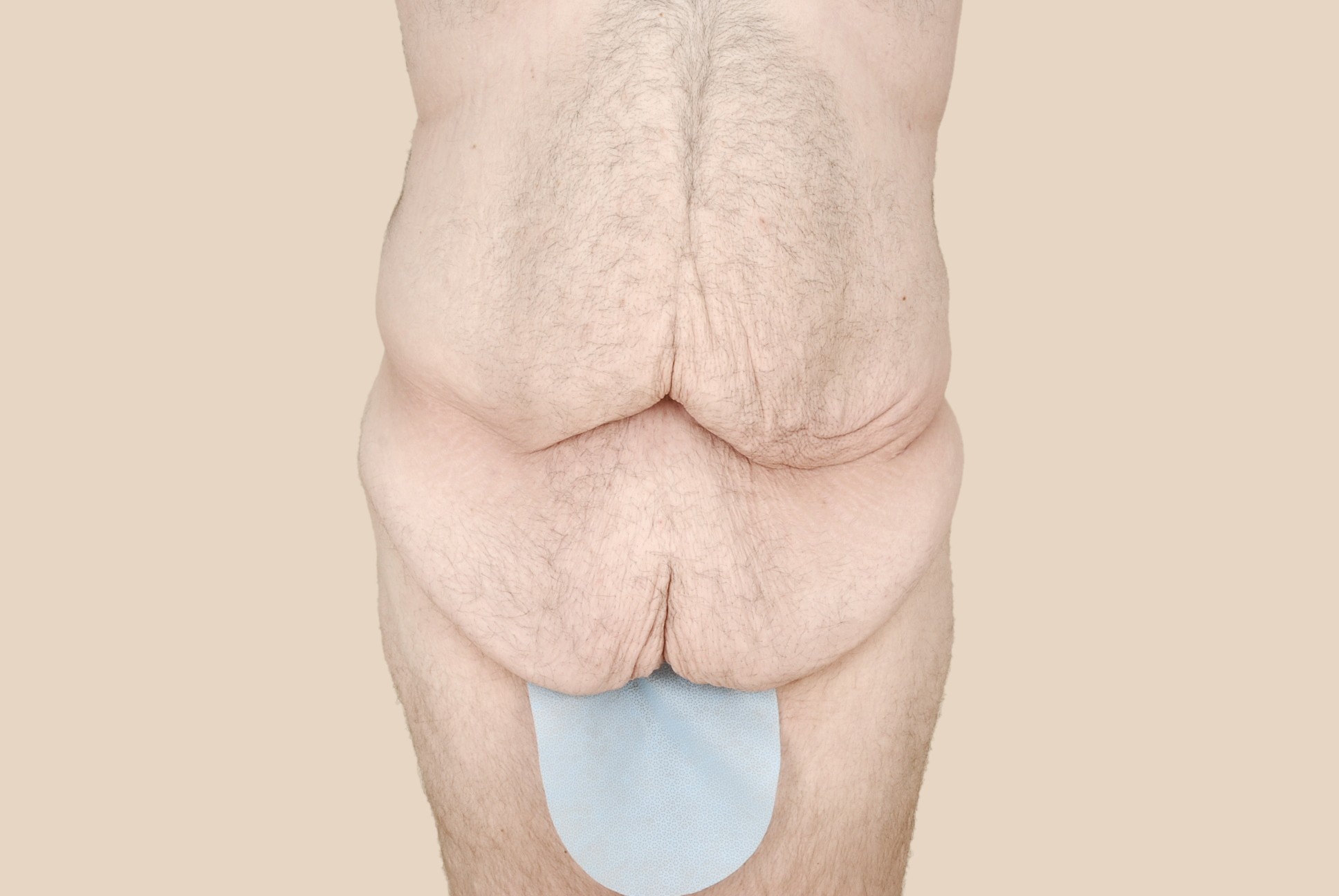 Body Lift Before & After Patient #510