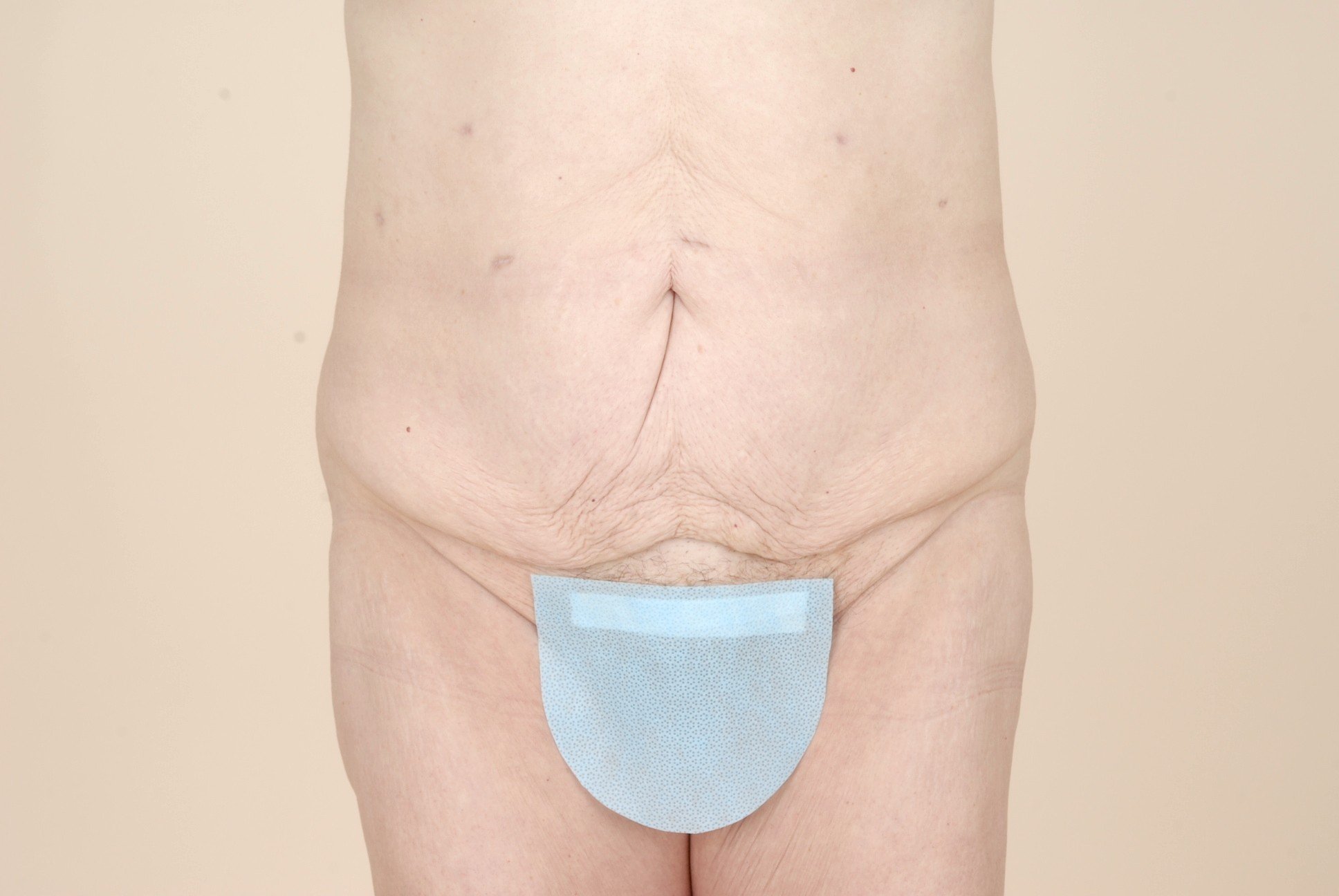 Body Lift Before & After Patient #536