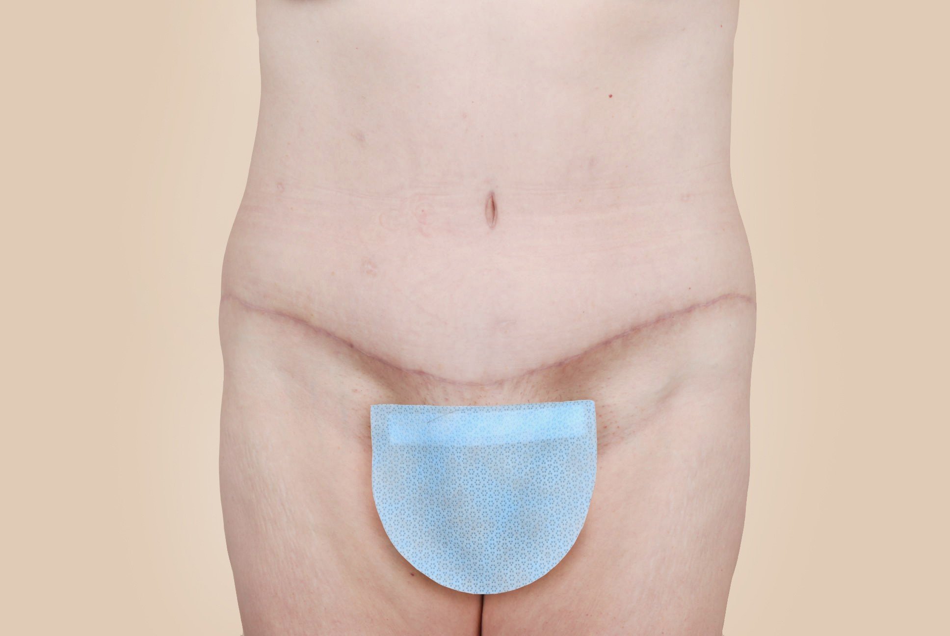 Body Lift Before & After Patient #536