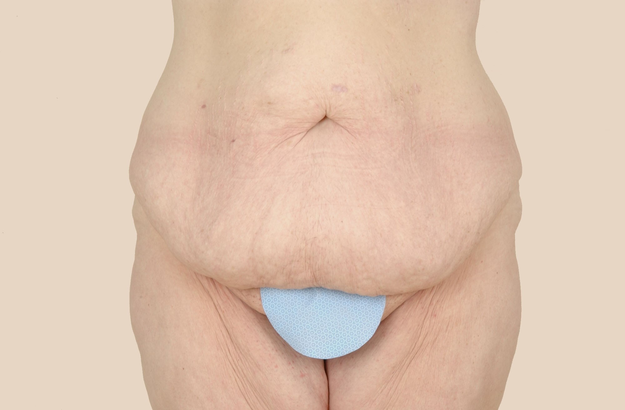 Tummy Tuck Before & After Patient #541