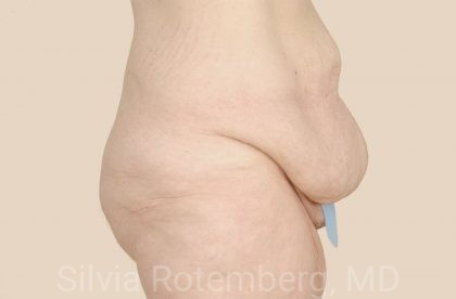 Tummy Tuck Before & After Patient #541