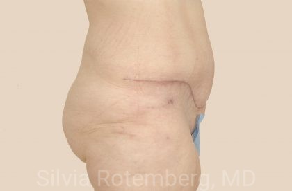 Tummy Tuck Before & After Patient #541