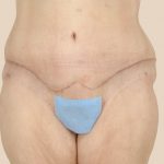 Tummy Tuck Before & After Patient #541