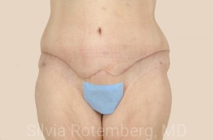 Tummy Tuck Before & After Patient #541