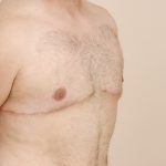 Gynecomastia Before & After Patient #424