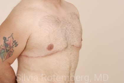 Gynecomastia Before & After Patient #424