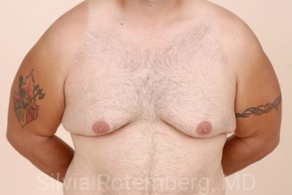 Gynecomastia Before & After Patient #424