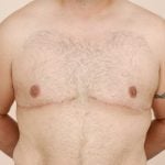 Gynecomastia Before & After Patient #424