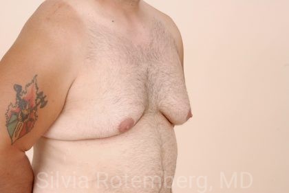 Gynecomastia Before & After Patient #424