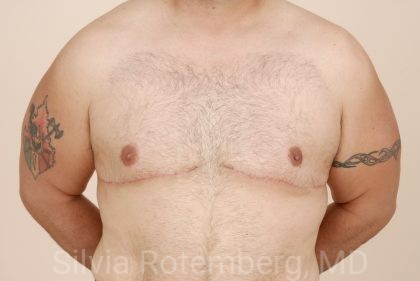 Gynecomastia Before & After Patient #424