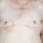 Gynecomastia Before & After Patient #429