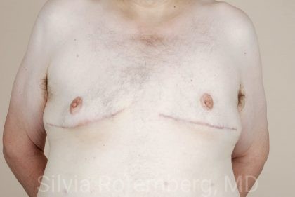 Gynecomastia Before & After Patient #429