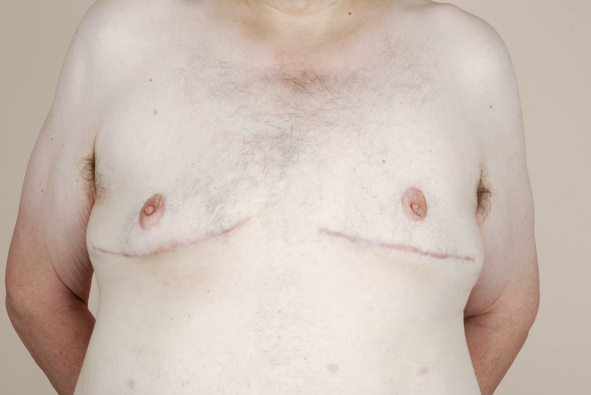 Gynecomastia Before & After Patient #429
