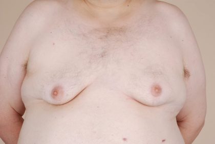 Gynecomastia Before & After Patient #429