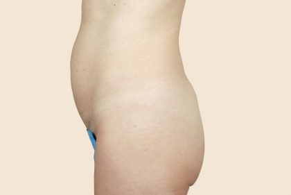 Tummy Tuck Before & After Patient #444