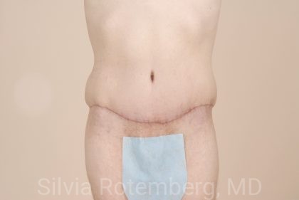 Tummy Tuck Before & After Patient #446
